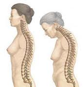 Τα οστεοπορωτικά κατάγματα σπονδυλικής στήλης και η απώλεια ύψους στις γυναίκες.